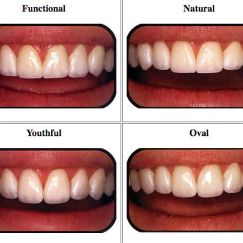 Can spell veneers fix gaps in your teeth?